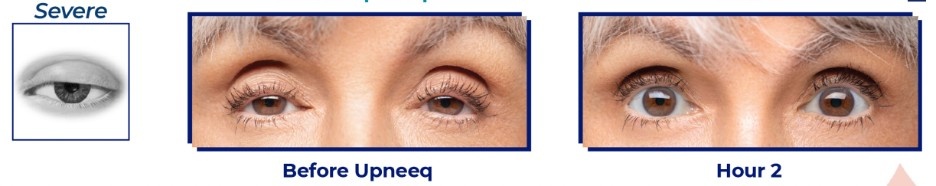 UPNEEQ before and after results at Epicentre Skincare & Laser Center in Dallas, TX